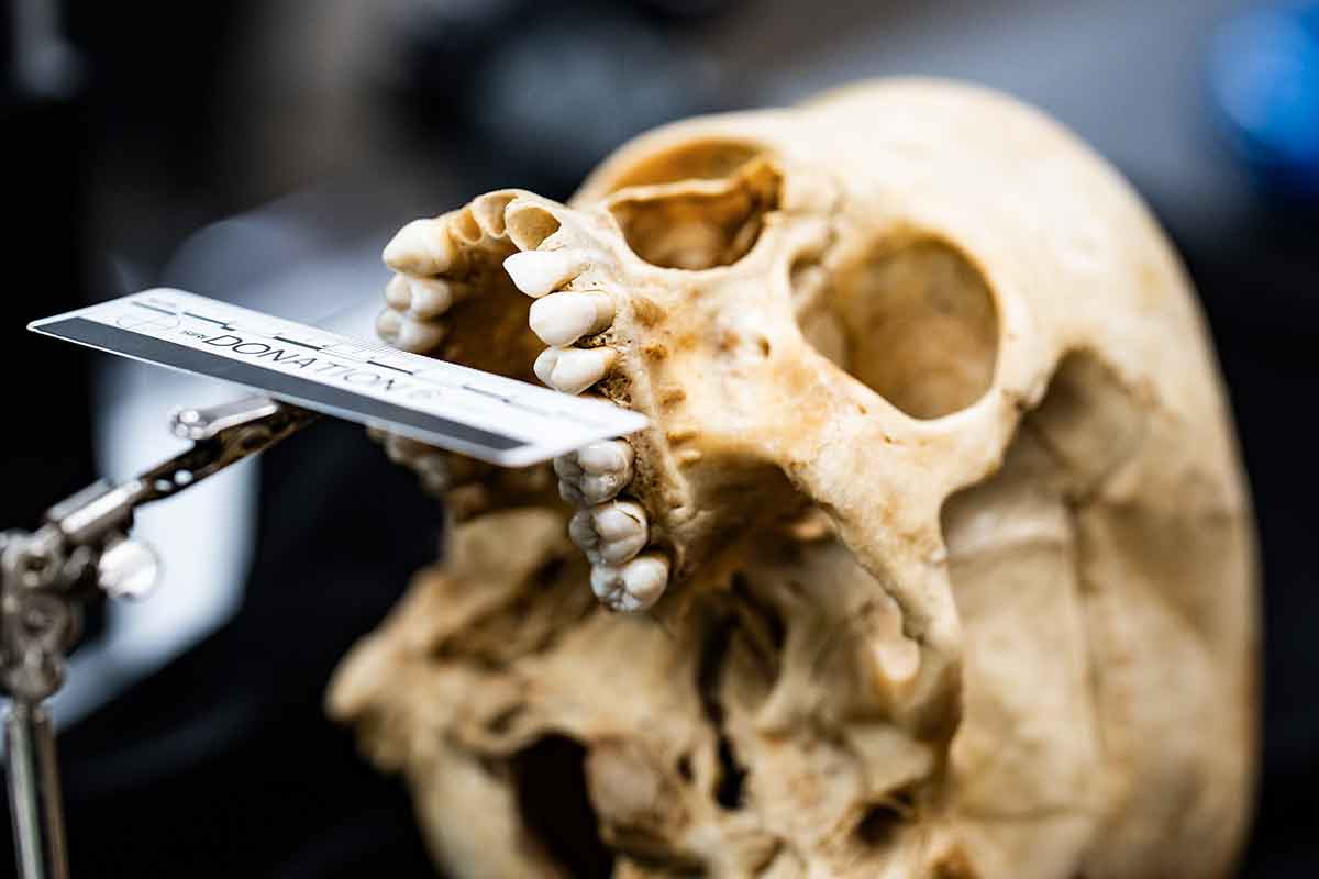 A human skull with an intact top row of teeth and a tag that reads Donation